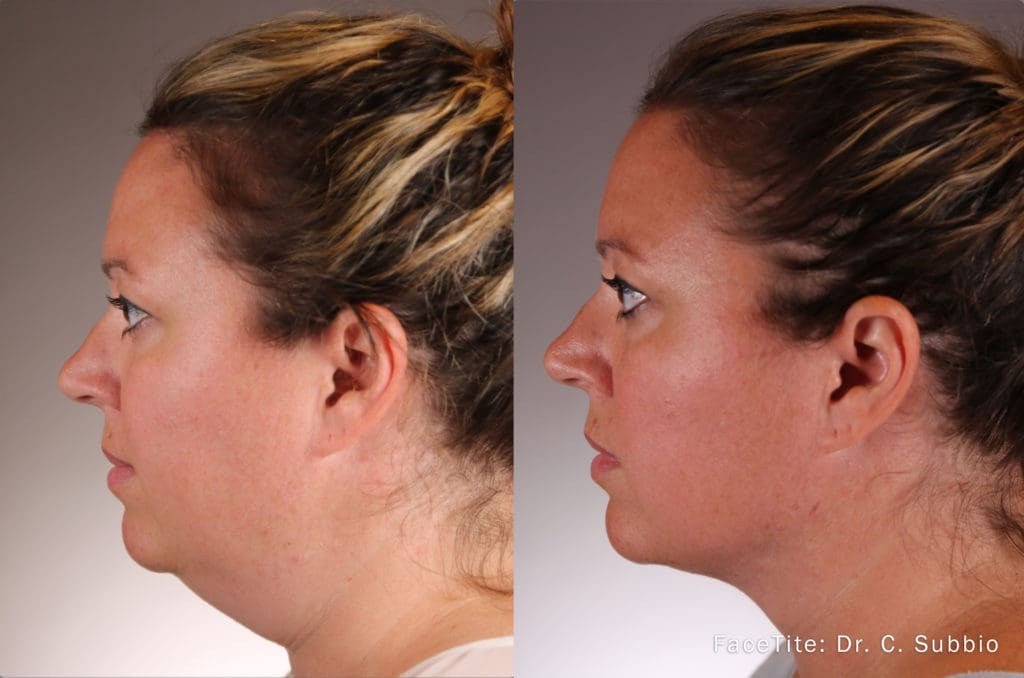 FaceTite, BodyTite and AccuTite in West Palm Beach and Jupiter, FL