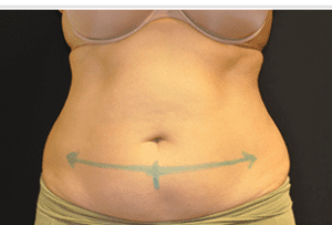 CoolSculpting Before and After Pictures West Palm Beach, FL