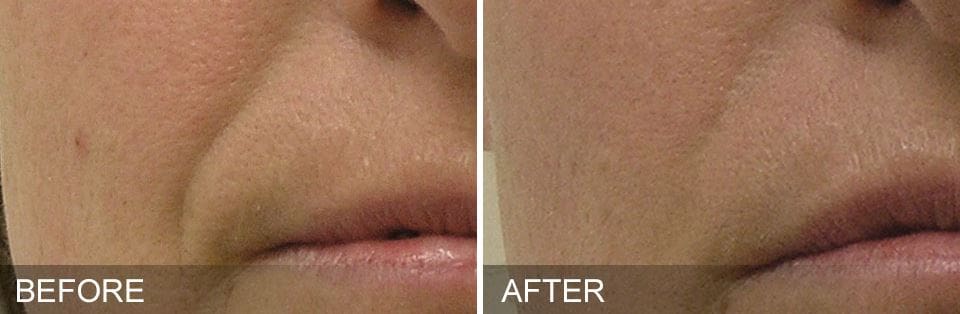 HydraFacial MD® in West Palm Beach and Jupiter, FL