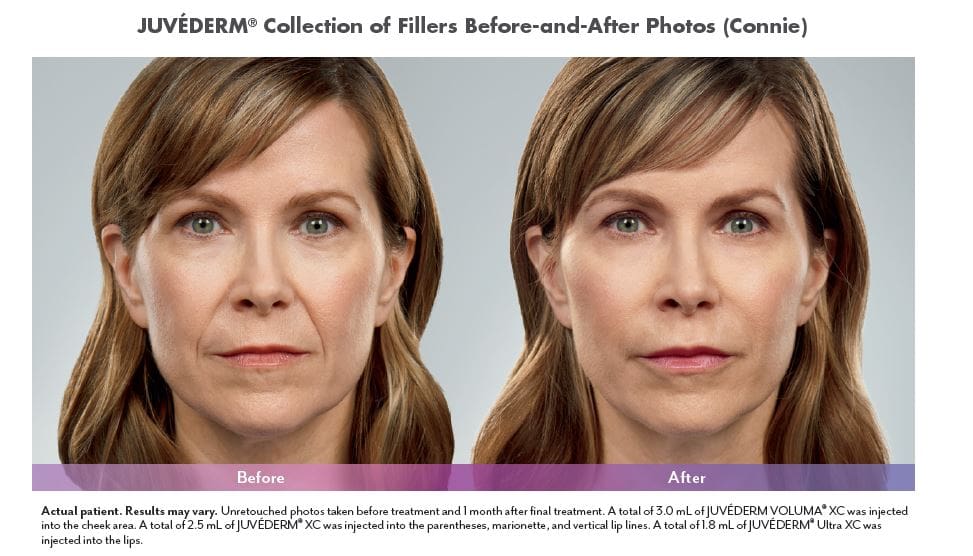 Juvederm Before and After 3 Juvéderm® in West Palm Beach and Jupiter, FL
