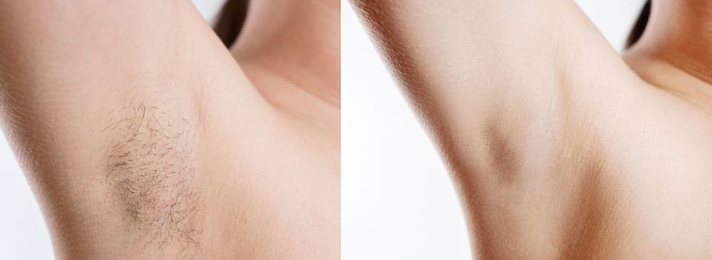 Laser Hair Removal in West Palm Beach and Jupiter, FL