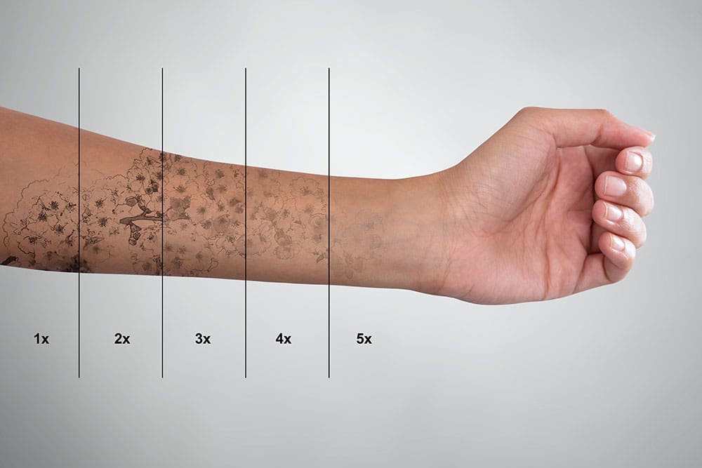 Laser Tattoo Removal in West Palm Beach and Jupiter, FL