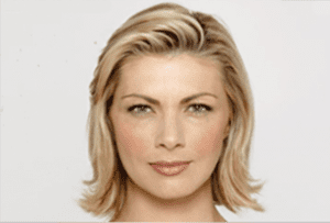 Botox Before and After Pictures West Palm Beach, FL