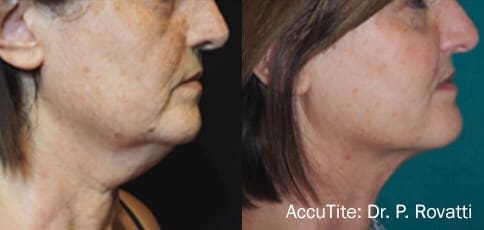 FaceTite, BodyTite and AccuTite in West Palm Beach and Jupiter, FL