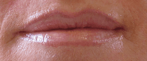 Lip Rejuvenation Before and After Pictures West Palm Beach, FL
