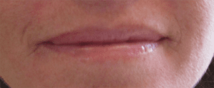 Lip Rejuvenation Before and After Pictures West Palm Beach, FL