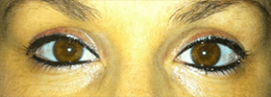 Permanent Makeup Before and After Pictures West Palm Beach, FL