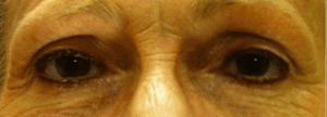 Permanent Makeup Before and After Pictures West Palm Beach, FL