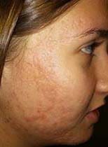 Microneedling Before and After Pictures West Palm Beach, FL