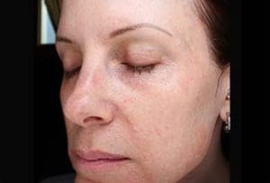 Microneedling Before and After Pictures West Palm Beach, FL