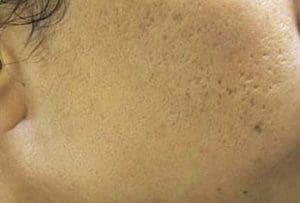 Microneedling Before and After Pictures West Palm Beach, FL