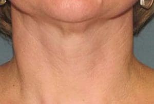 Microneedling Before and After Pictures West Palm Beach, FL