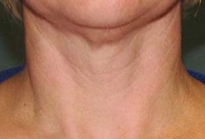 Microneedling Before and After Pictures West Palm Beach, FL