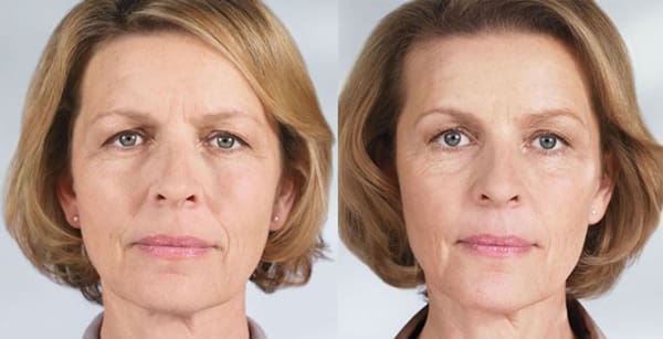 Sculptra® in West Palm Beach and Jupiter, FL