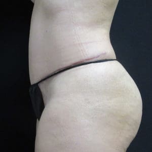 Abdominoplasty Before and After Pictures West Palm Beach, FL