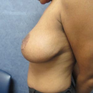 Breast Reduction Before and After Pictures West Palm Beach, FL