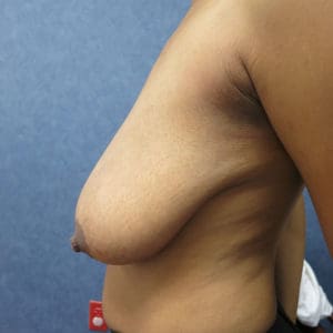 Breast Reduction Before and After Pictures West Palm Beach, FL