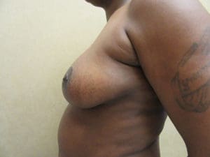 Breast Reduction Before and After Pictures West Palm Beach, FL