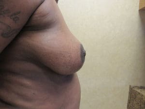 Breast Reduction Before and After Pictures West Palm Beach, FL