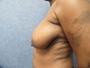 Breast Reduction Before and After Pictures West Palm Beach, FL