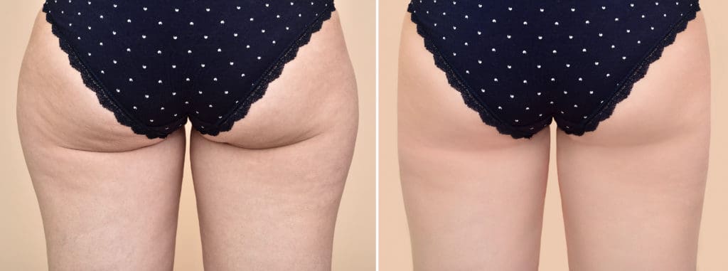 Cellulite Treatment in West Palm Beach and Jupiter, FL