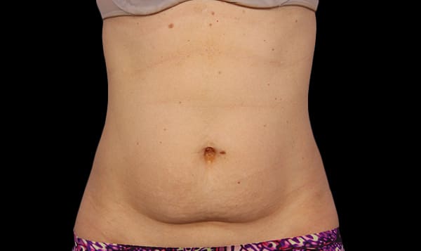 CoolSculpting® in West Palm Beach and Jupiter, FL