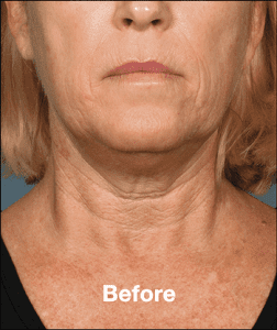 Kybella Before and After Pictures West Palm Beach, FL